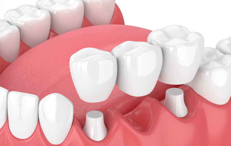 Treatment - Carnaby Street Dental