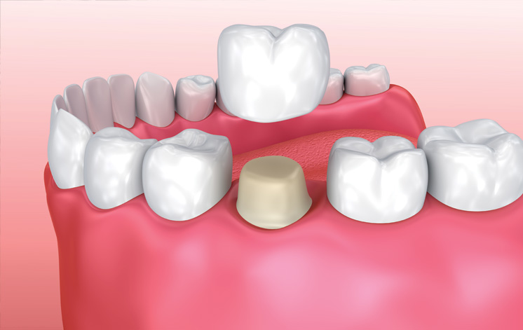 Treatment - Carnaby Street Dental